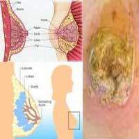 Medicine Acupuncture Herbal Treatment Cure Breast Cancer Kuala Lumpur Herbs Medical Treatment Cure Centre